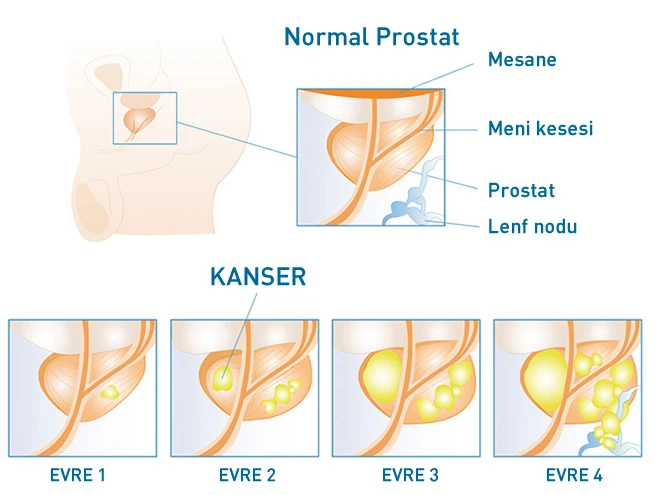 Prostat Kanseri Neden Olur? Prostat Kanseri Öldürür mü?